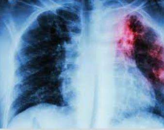 Fibrose pulmonaire traitement