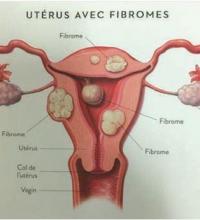 Uterus avec fibrome
