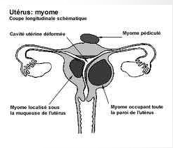 uterus-avec-fibrome.png