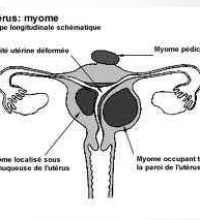 uterus-avec-fibrome.png
