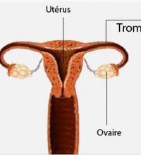 Uterus femme 2